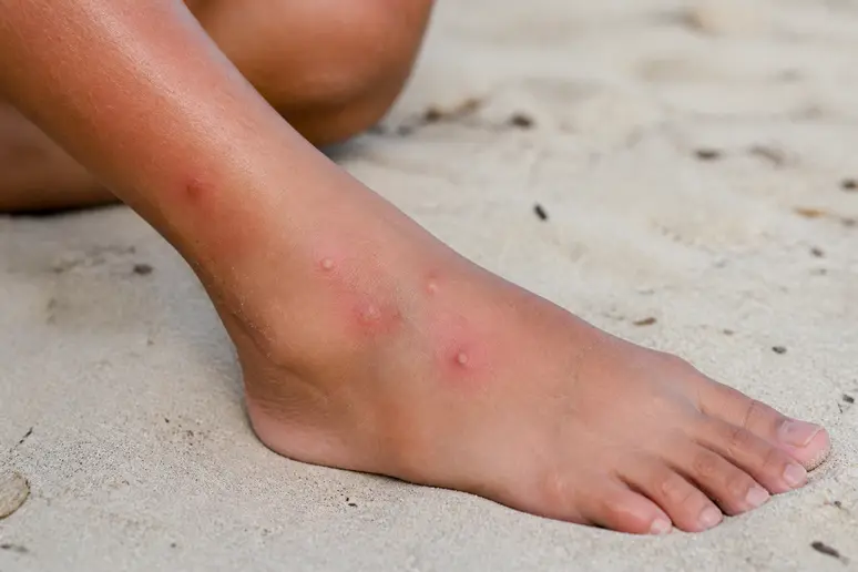 Fokus auf feine Hautirritationen am Fuß einer Thai-Frau, die auf Sandflohbisse hindeuten, mit leichter Rötung und Schwellung.